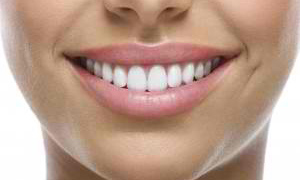 Teeth Whitening in Joondalup