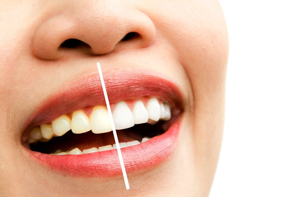 Teeth Whitening Joondalup